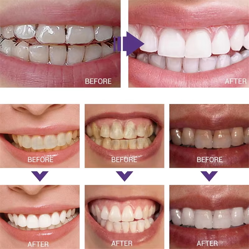 Teeth Cleansing Whitening Toot - Teeth Whitening Korea review and price