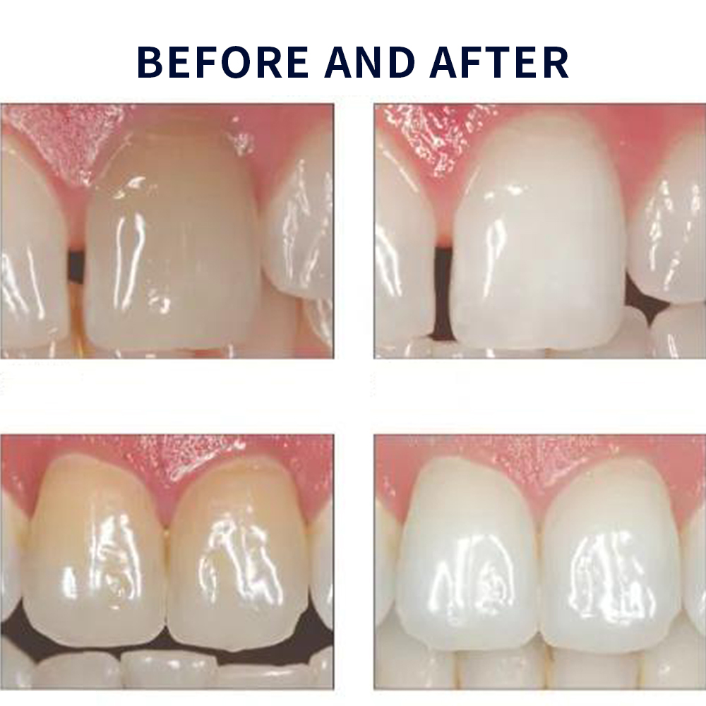 Opalescence Whitening 20% PF 2 - Teeth Whitening App review and price