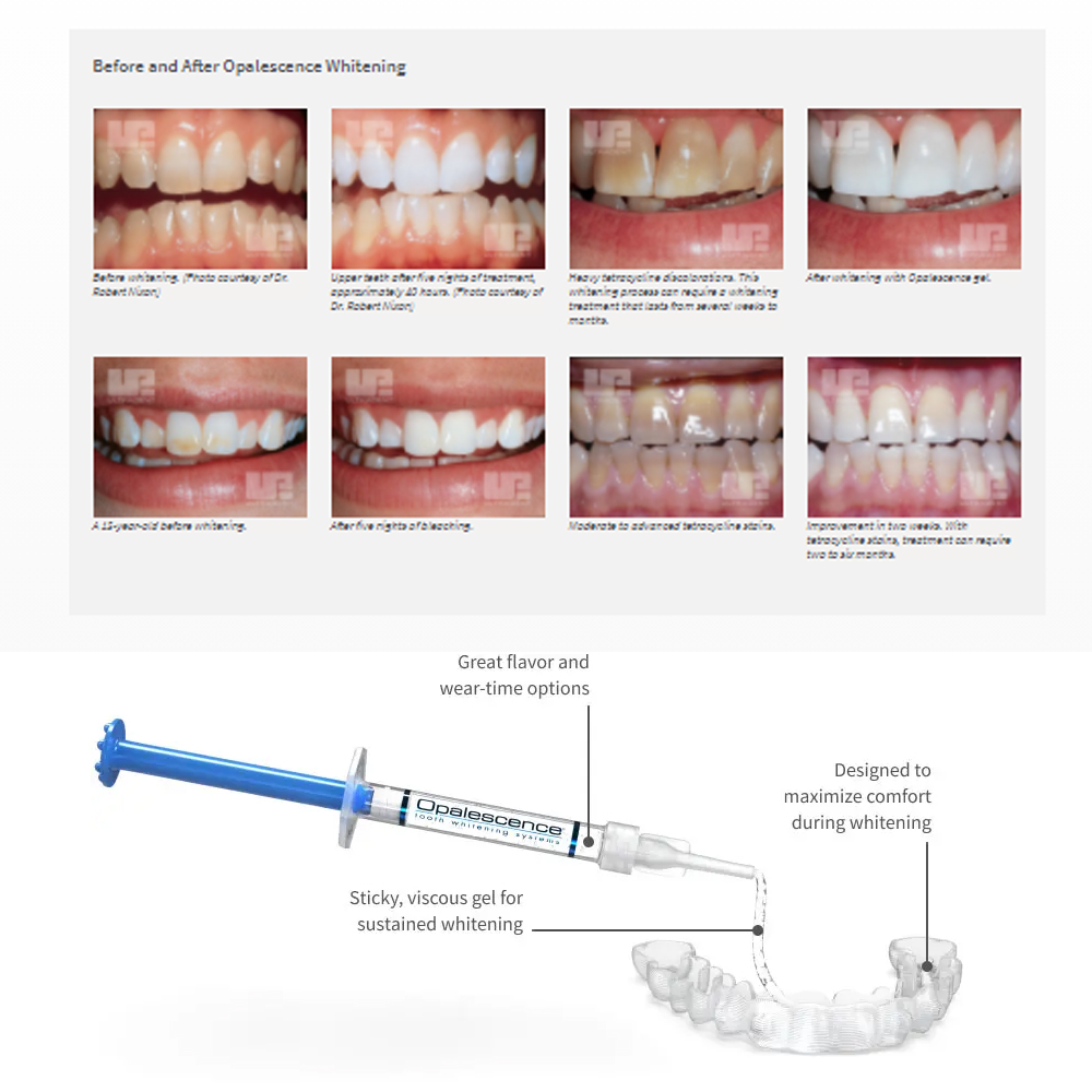 Opalescence Whitening 20% PF 2 - Teeth Whitening App review and price