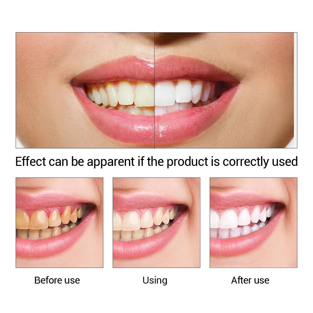 FTEENPLY Teeth Whitening Essen - Teeth Whitening Groupon review and price