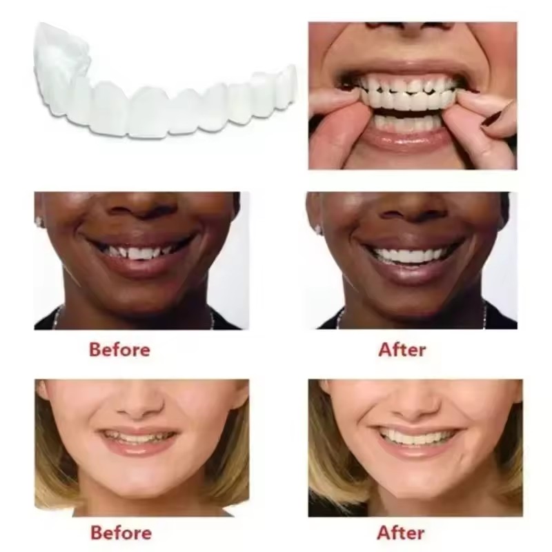 Teeth Veneers Whitening Dentur - Teeth Whitening Veneers review and price