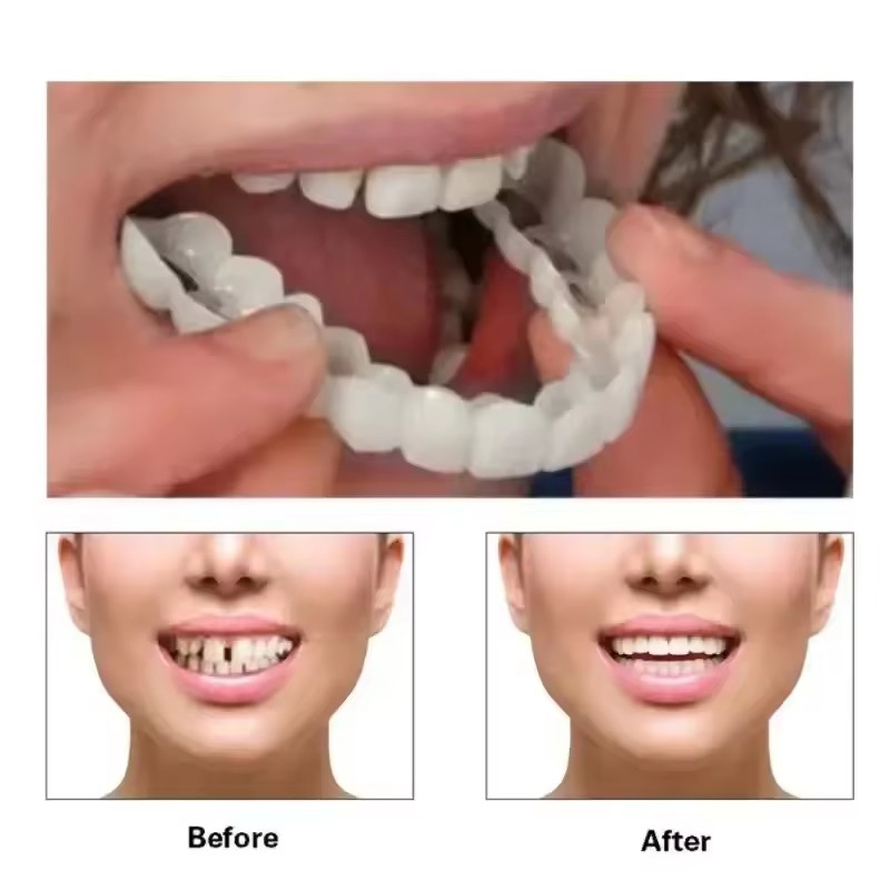 Teeth Veneers Whitening Dentur - Teeth Whitening Veneers review and price