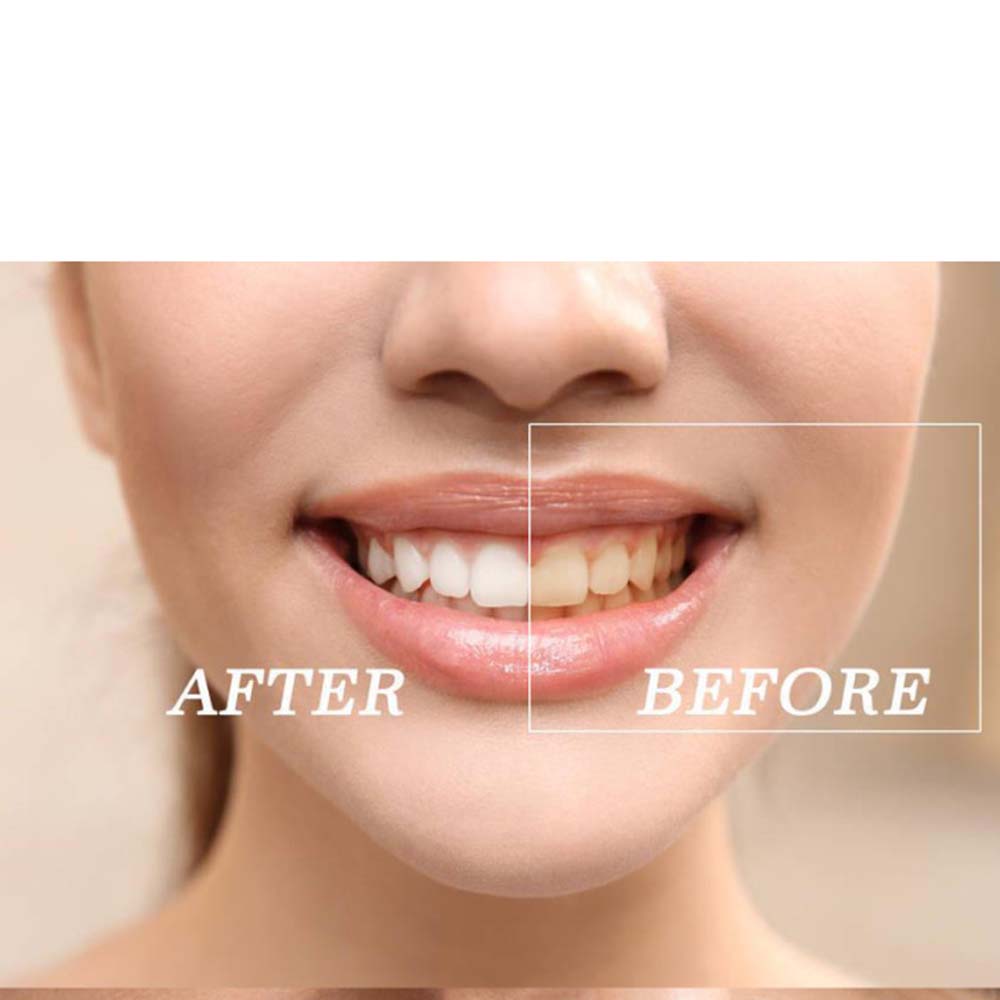 Top Quality Peroxide Teeth Whi - Teeth Whitening Gel Peroxide review and price