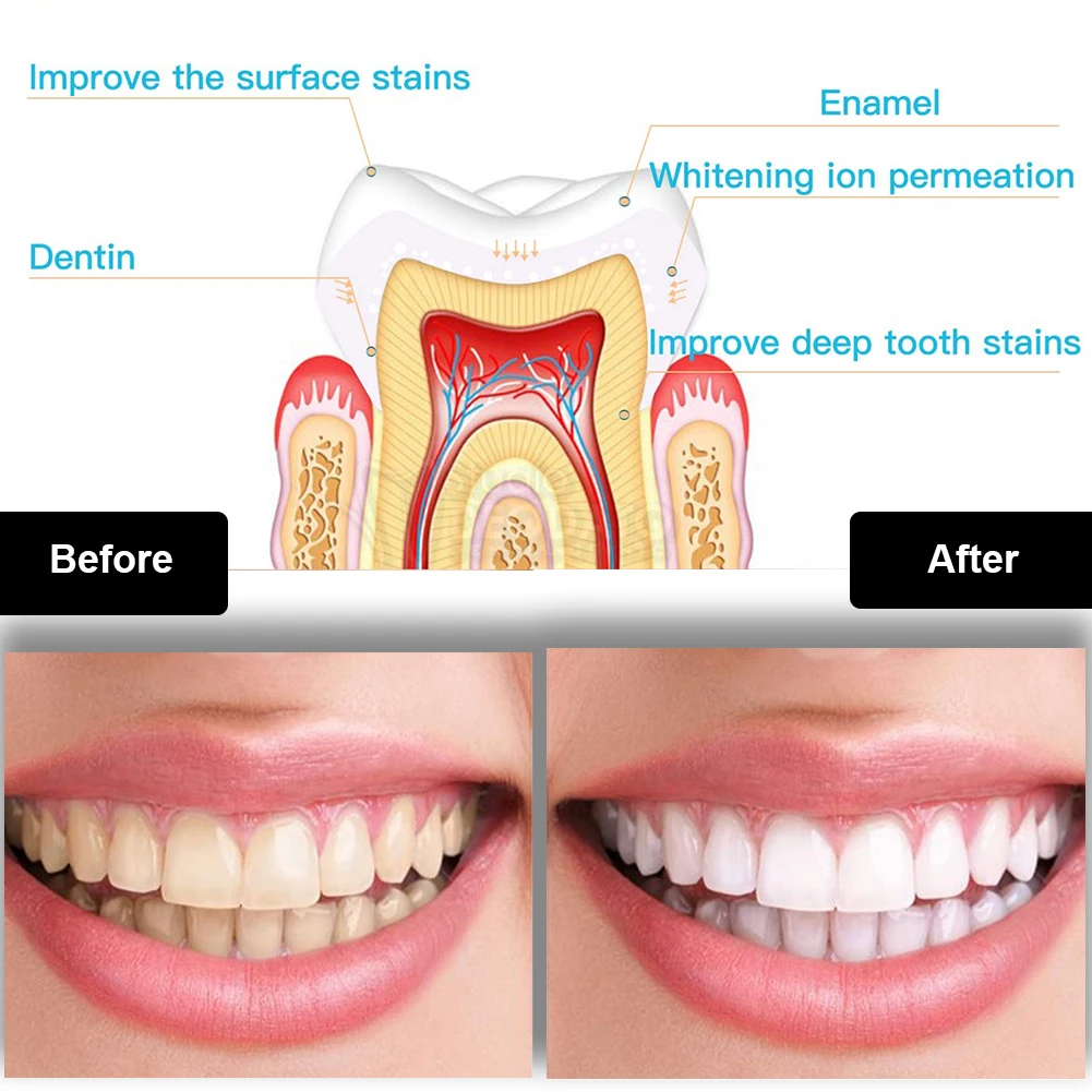 Dental Teeth Whitening Kit Min - Teeth Whitening Gel Peroxide review and price