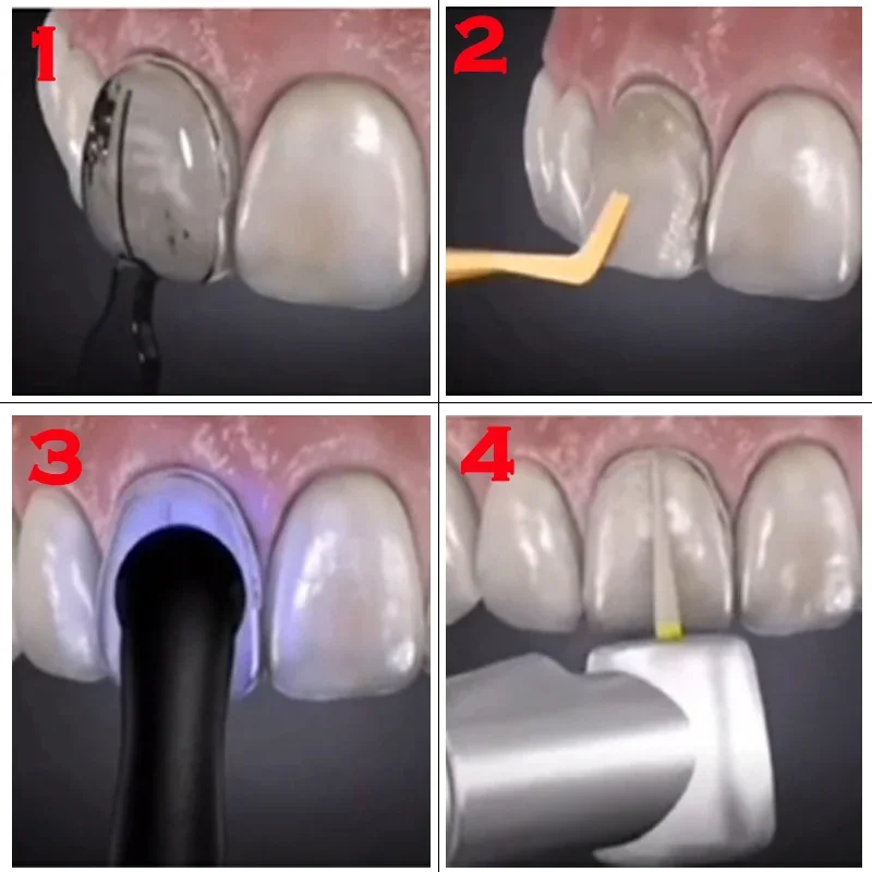 Dentals Mould For Composite Re - Teeth Whitening Veneers review and price